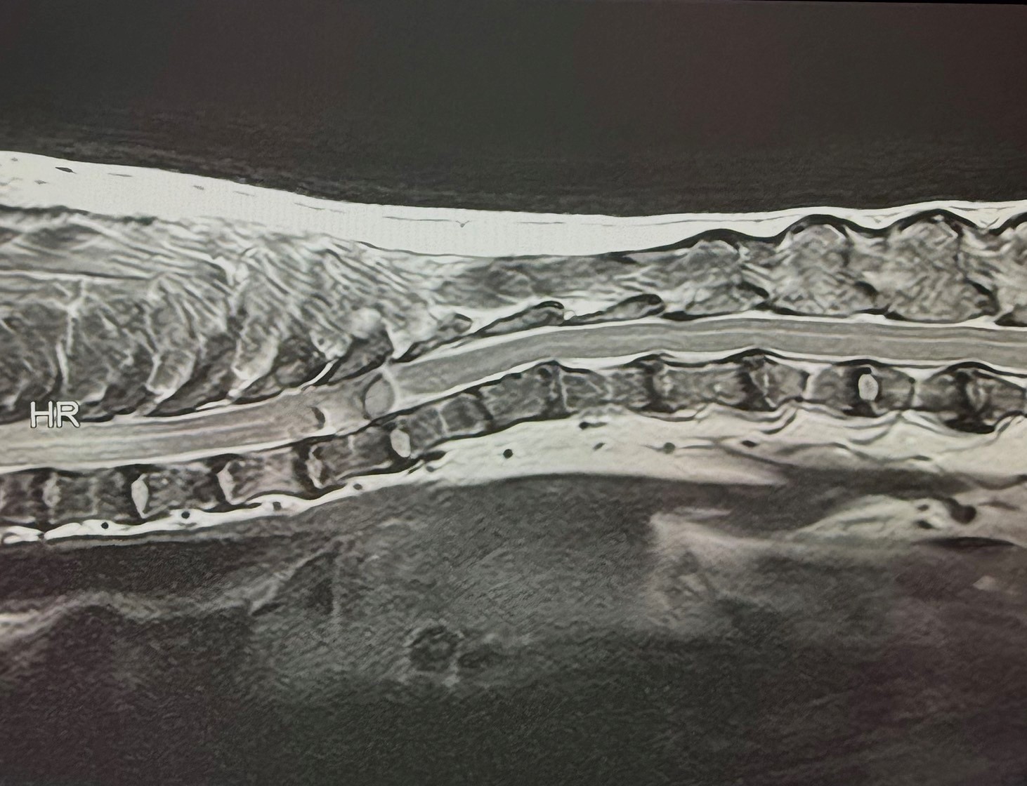 犬の脊髄腫瘍に対し椎弓切除術を実施し、病理検査で悪性末梢神経鞘腫瘍と診断された１例の画像